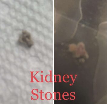 The image is a side-by-side comparison of two kidney stones. The left side shows a small, brownish stone on a white background, likely a surface or tissue. The right side appears to be an internal medical image, possibly an x-ray or scan, showing a larger, more irregularly shaped kidney stone within what seems to be part of the urinary tract. The words 